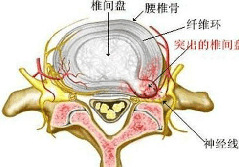 腰椎間盤突出癥的最新研究進展與治療策略綜述